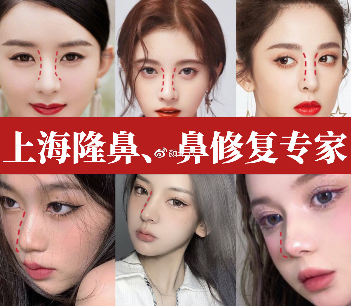 上海假体隆鼻价格多少钱?假体隆鼻手术费用及注意事项插图1 选择合适的服务提供商