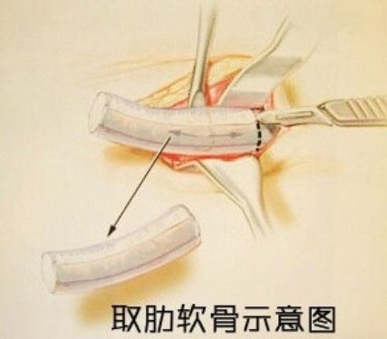 为什么在这种情况下,医生不愿意让你做肋软骨隆鼻?插图2 图片