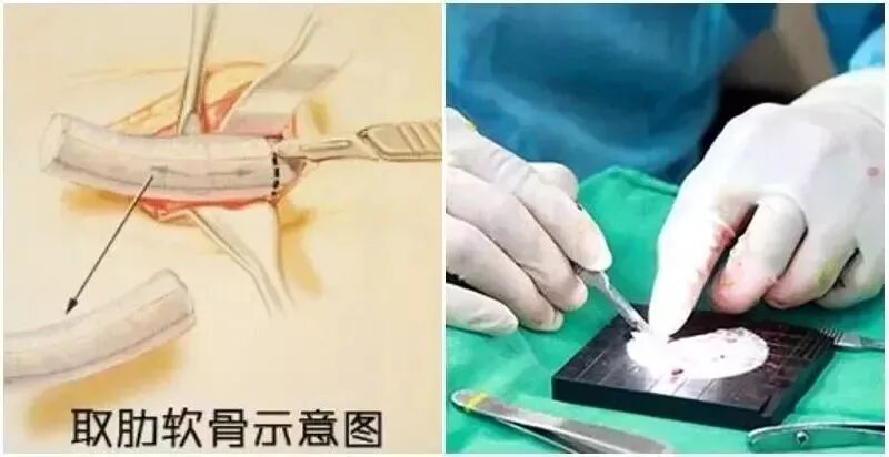 肋软骨鼻综合有哪些优缺点?插图1 图片