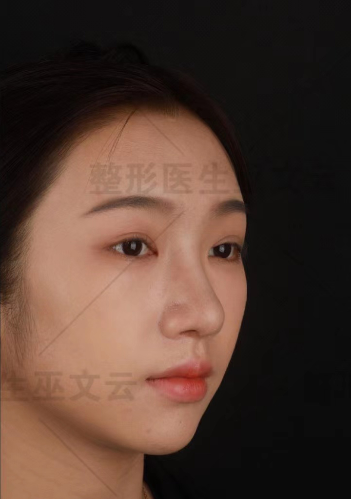 知名的鼻部整形医院,隆鼻手术前应做哪些准备插图 知名的鼻部整形医院,隆鼻手术前应做哪些准备插图