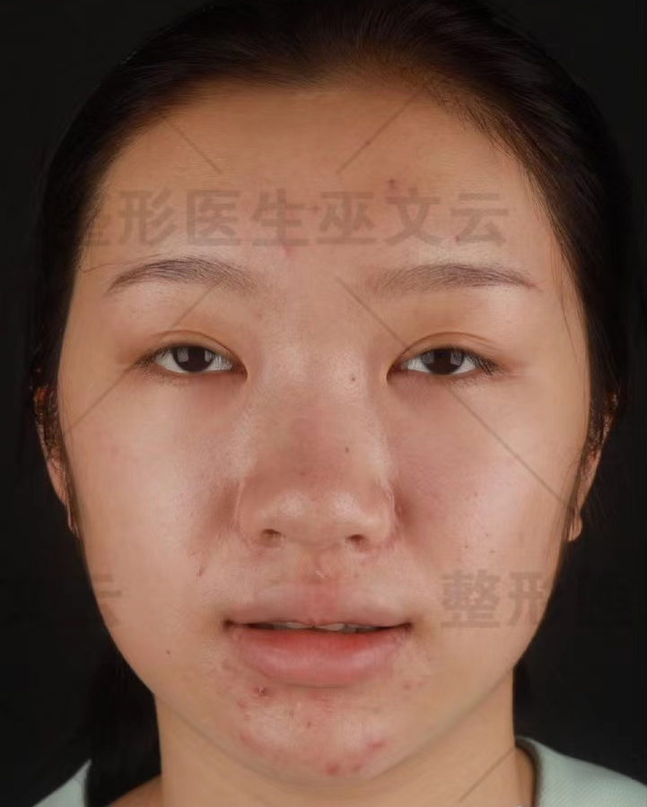 术前