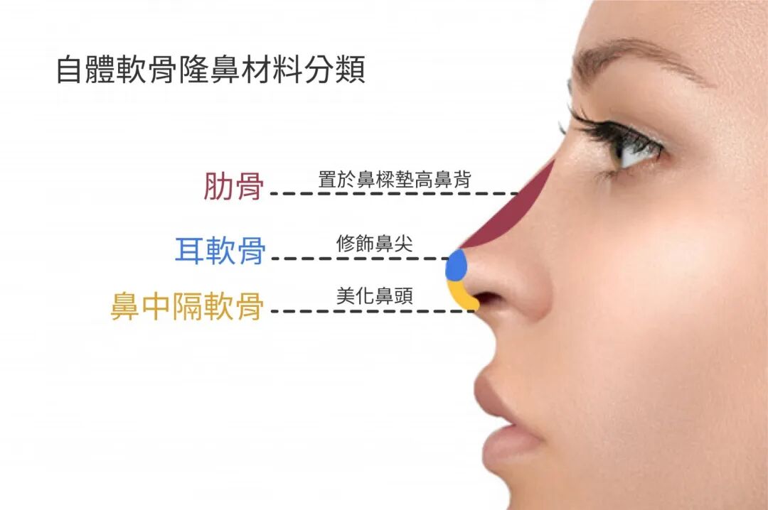 自体软骨隆鼻好不好?自体软骨隆鼻软骨取走的地方会不会塌陷?插图 图片