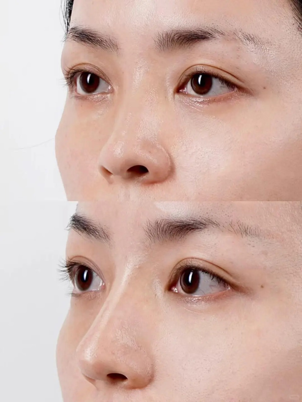 隆鼻有什么风险?隆鼻有哪几种鼻型?插图 图片