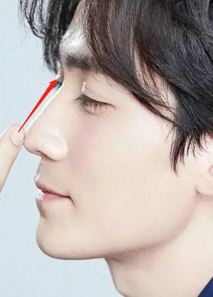 男生隆鼻多少钱一次?男生隆鼻跟女生有什么不同?插图 图片