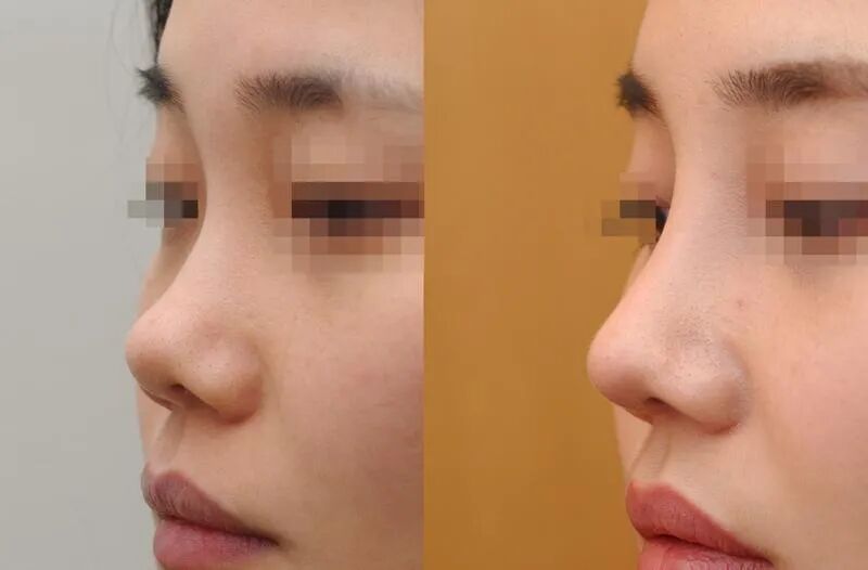 隆鼻哪家医院比较好?隆鼻几年需要修复?插图 图片