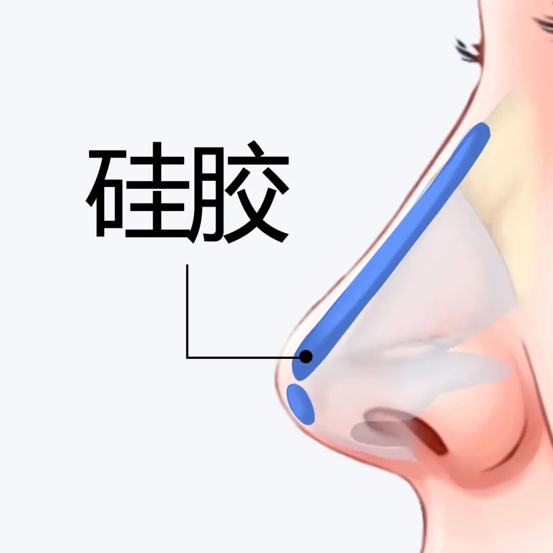 硅胶隆鼻可以保持一辈子吗?做隆鼻需要大概多少钱?插图 图片