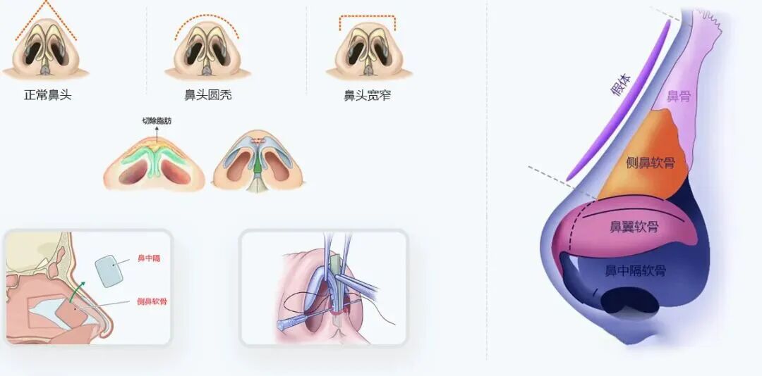 肋骨隆鼻会吸收吗?肋骨隆鼻怎么取肋骨?插图 图片