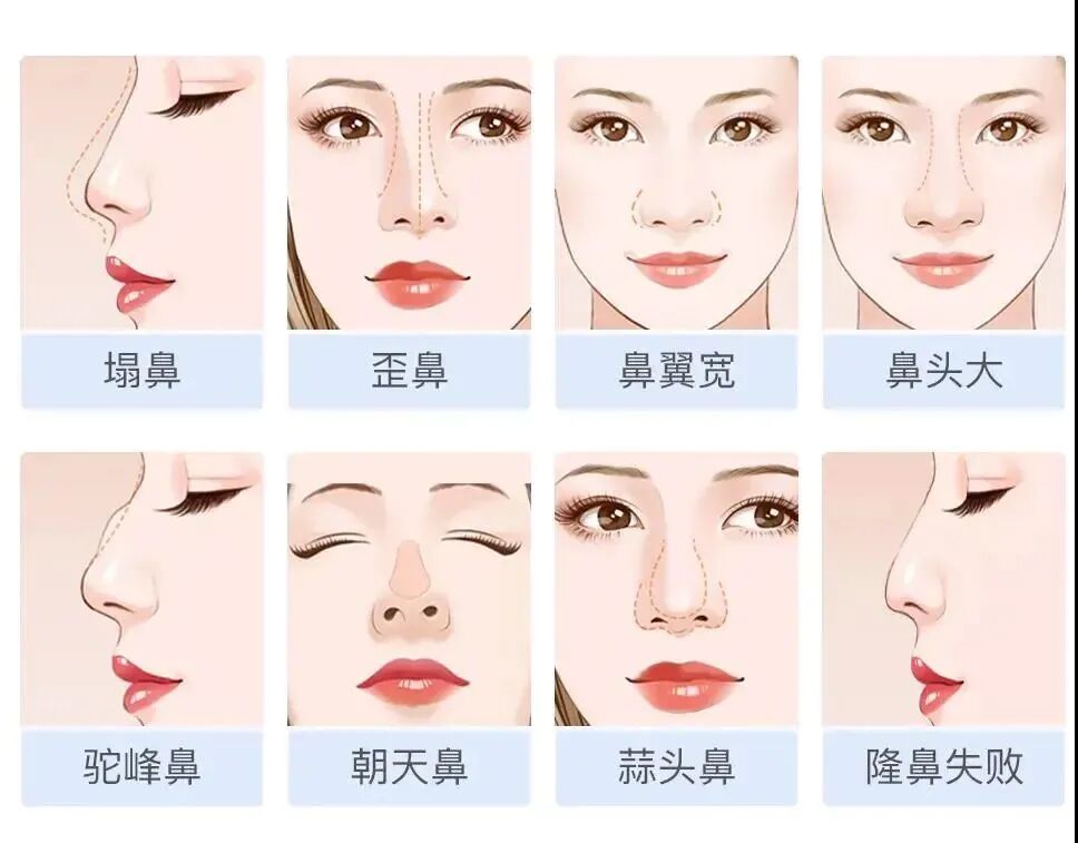 隆鼻能做出任何想要的鼻形吗?隆鼻要注意什么?插图 图片