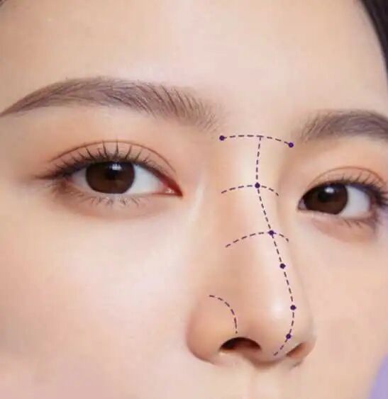 隆鼻什么情况下需要修复?隆鼻修复后怎么护理?插图 图片