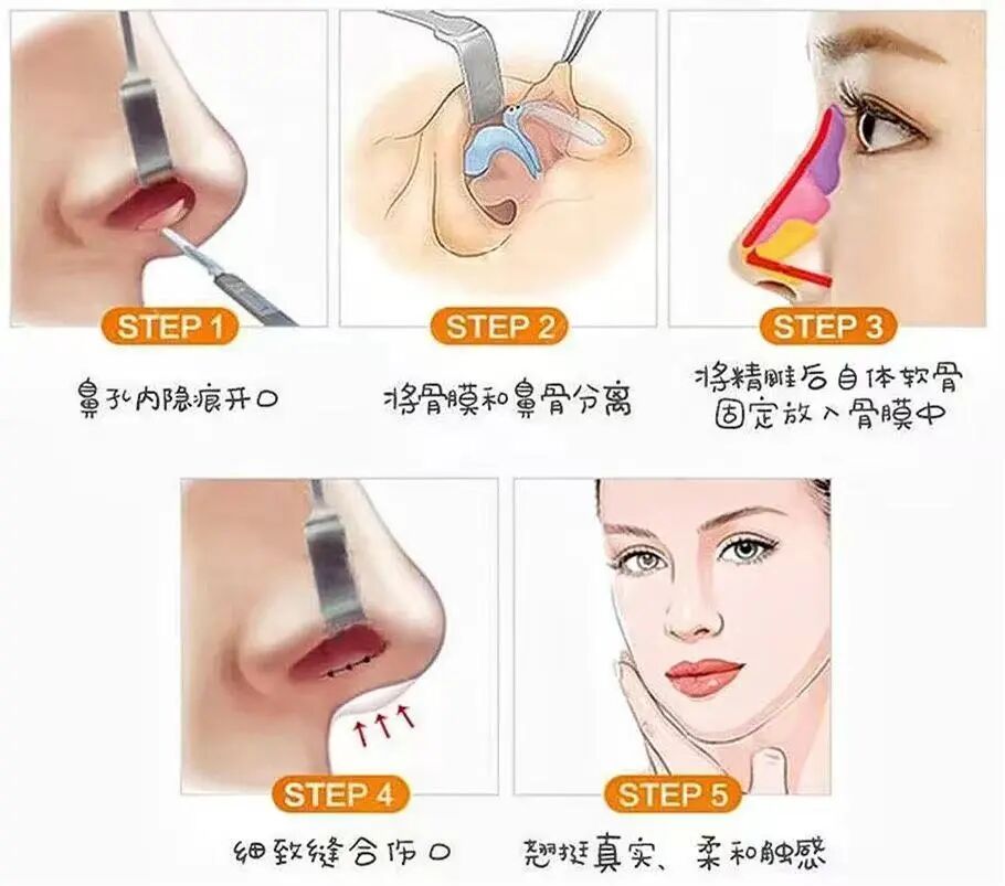 自体软骨隆鼻需要多少钱?自体软骨隆鼻的优势?插图 图片