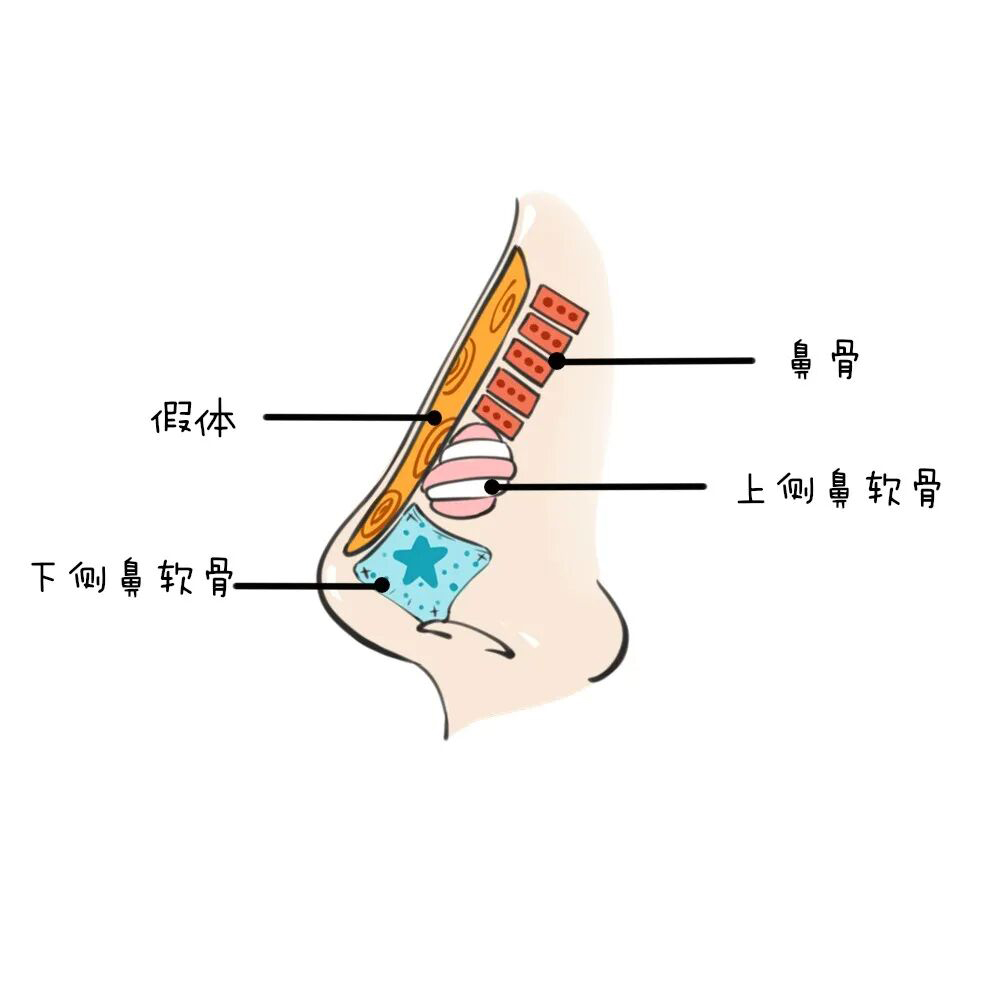 自体软骨隆鼻效果怎么样?自体软骨隆鼻能维持多久?插图 自体软骨隆鼻效果怎么样?自体软骨隆鼻能维持多久?插图