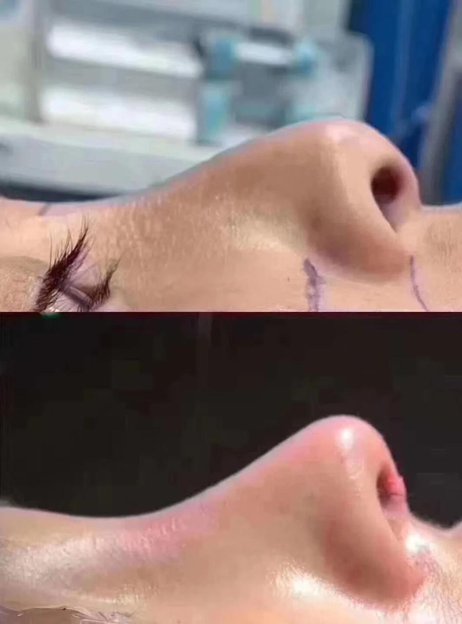 隆鼻后鼻子感染的症状是什么样的?隆鼻隆多高好看?插图 图片