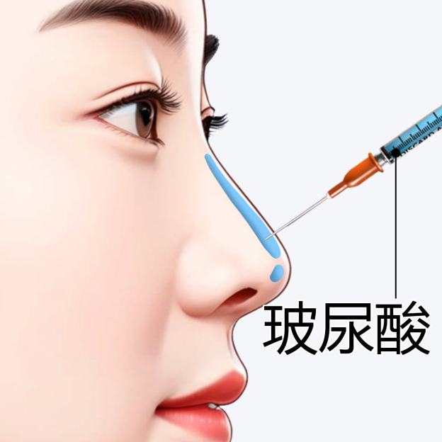 上海玻尿酸隆鼻价格多少钱？玻尿酸注射隆鼻费用及注意事项