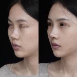 鼻综合手术价格多少钱？了解不同地区鼻综合整形费用差异