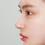隆鼻手术后鼻尖疼怎么办？隆鼻后取出假体能恢复原样吗？
